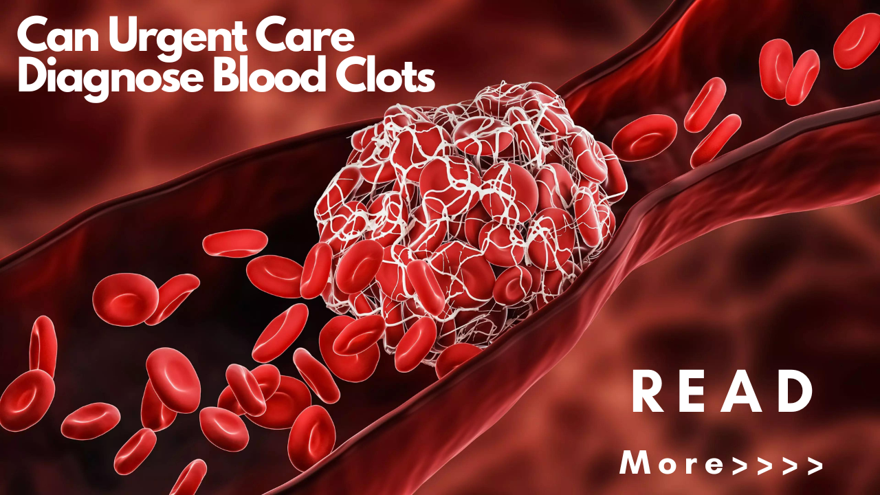 Unmasking the Hidden Threat - Can Urgent Care Diagnose Blood Clots